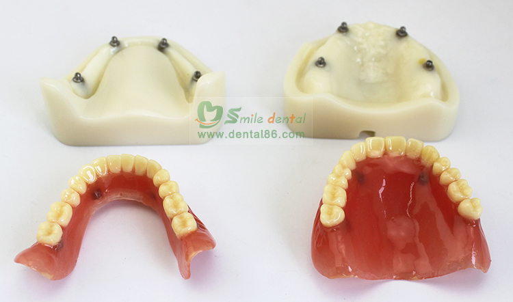 TM-T21 Full Denture Implant Mode